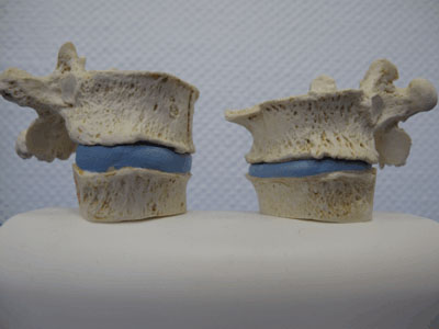 Normaler Knochen (links) / Osteoporotischer Knochen (rechts)